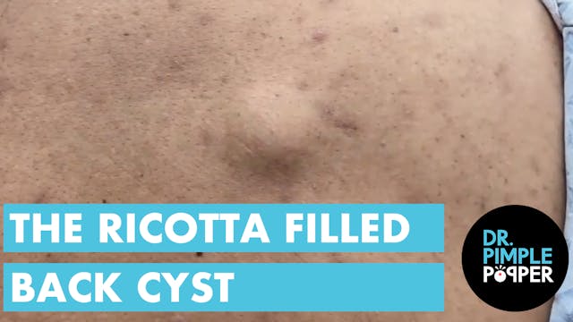 A Ricotta Filled Back Cyst