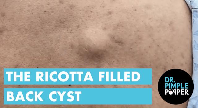 A Ricotta Filled Back Cyst