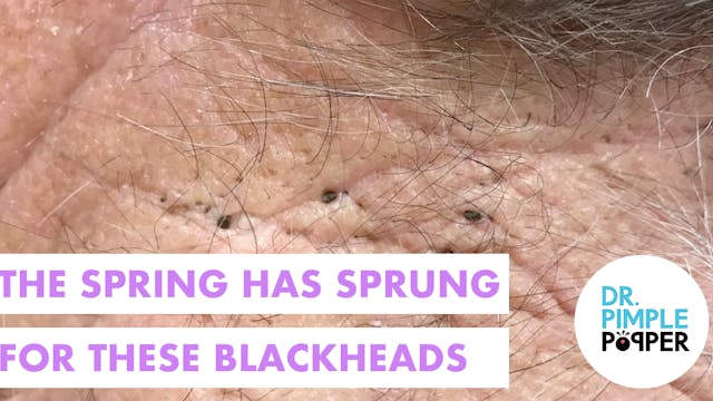 Blackheads in the Spring