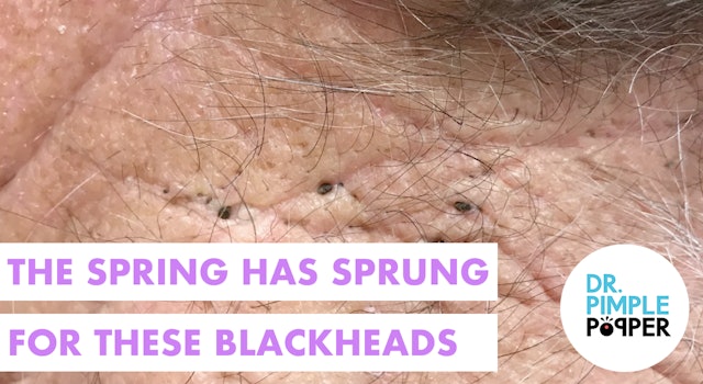 Blackheads in the Spring