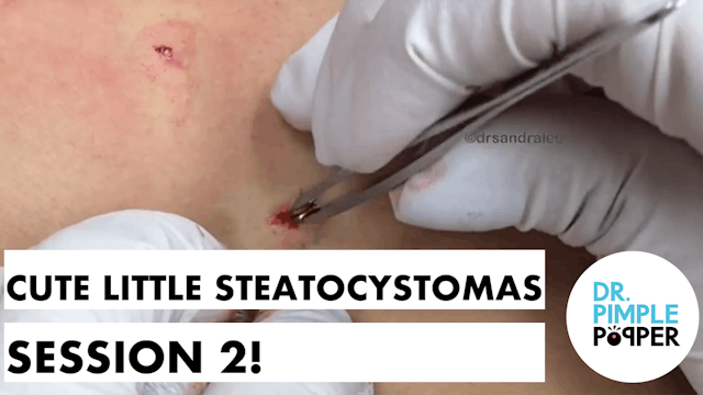 Cute Little Steatocystomas - Session 2!