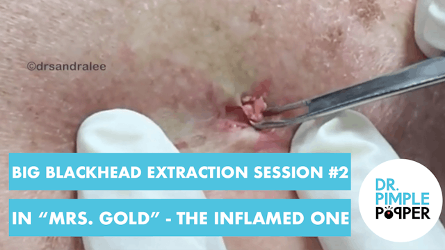 Back Blackhead Extraction Session #2 ...