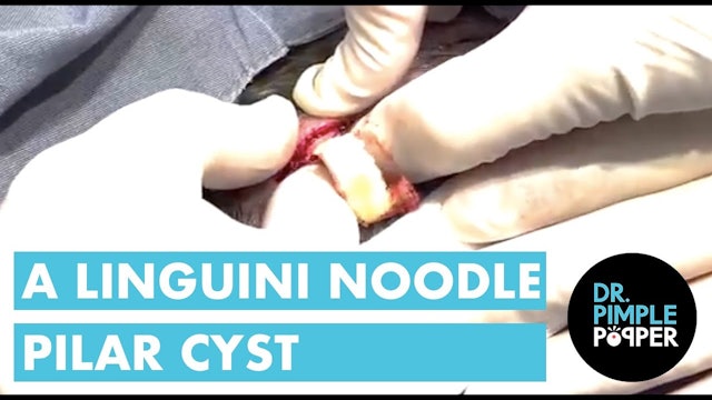 A Linguini Noodle Pilar Cyst