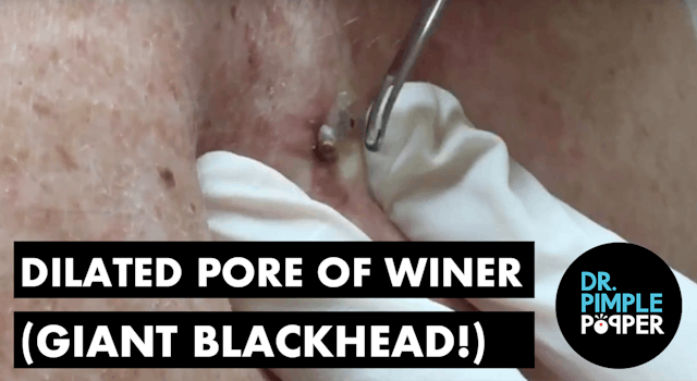 Dilated Pore of Winer (Giant blackhead!)