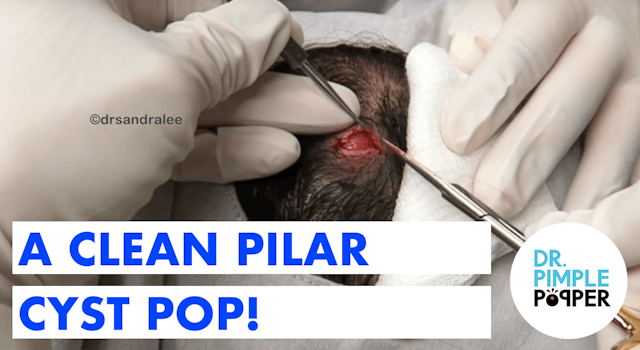 Clean Pilar Cyst Pop
