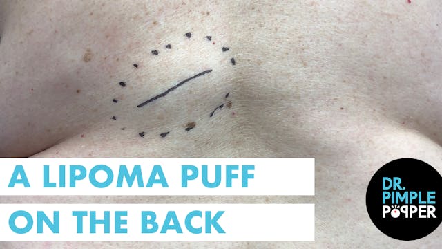 A Lipoma Puff on the Back