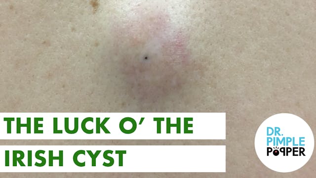 The Luck O' the Irish Cyst