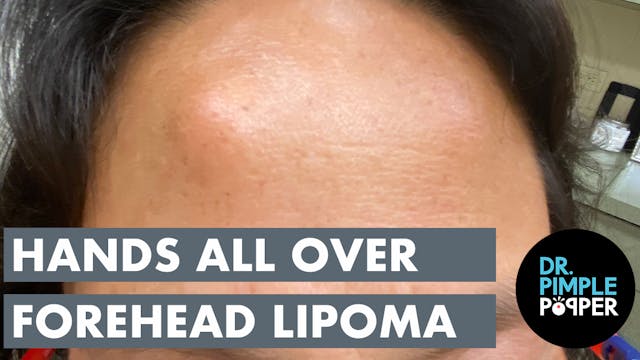 The Hands All Over Forehead Lipoma
