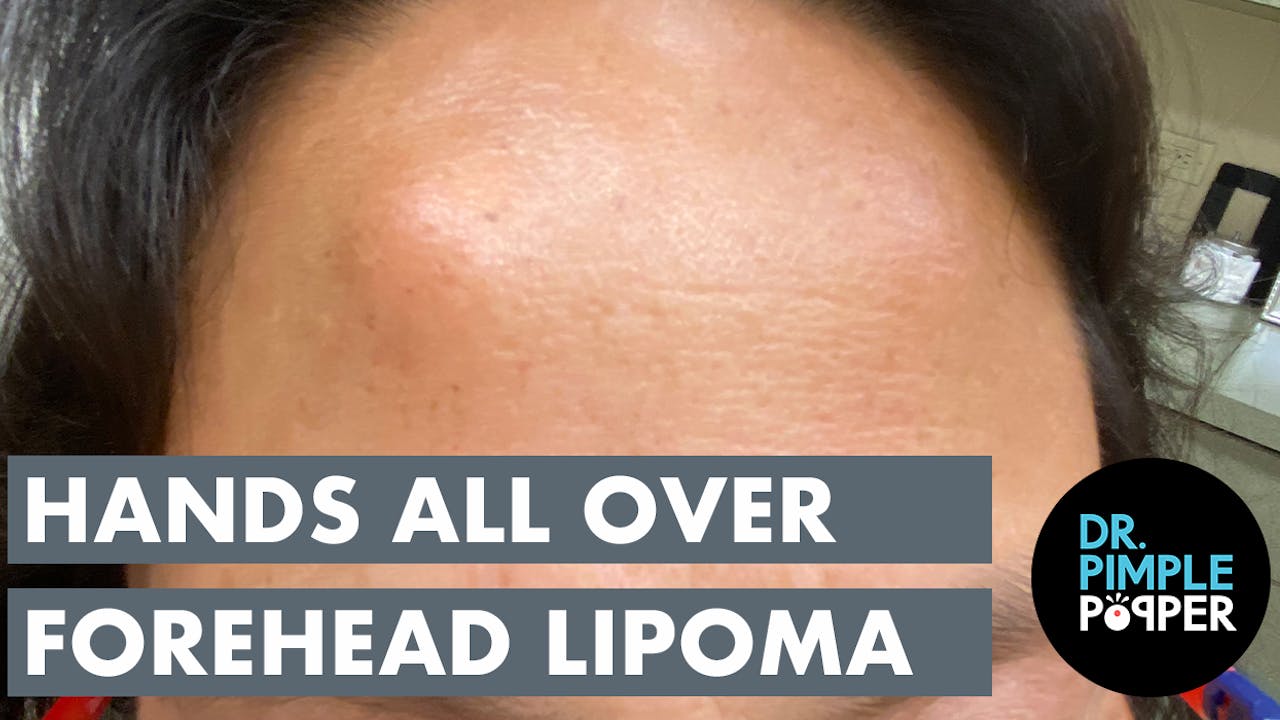 The Hands All Over Forehead Lipoma - Recently Added - Dr. Pimple Popper
