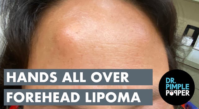 The Hands All Over Forehead Lipoma