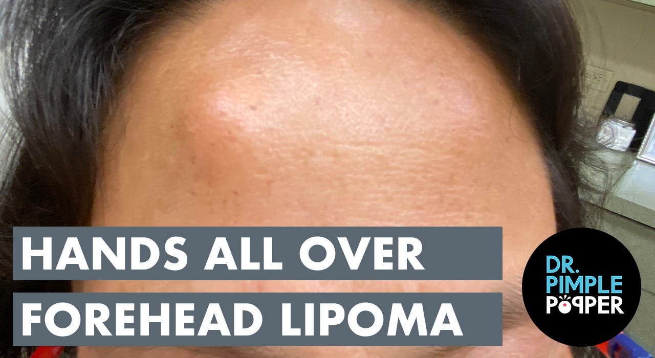 The Hands All Over Forehead Lipoma - Recently Added - Dr. Pimple Popper
