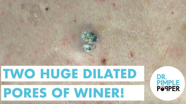 Two Huge Dilated Pores of Winer!