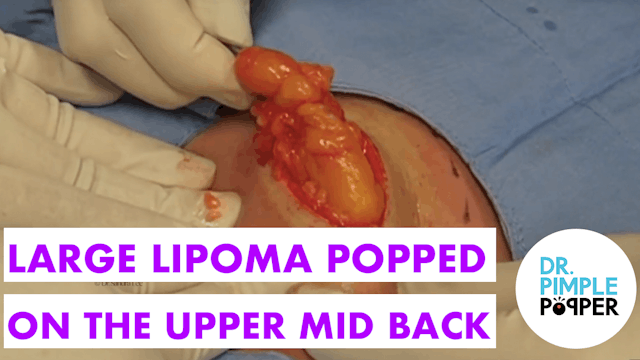Large Lipoma on the Back