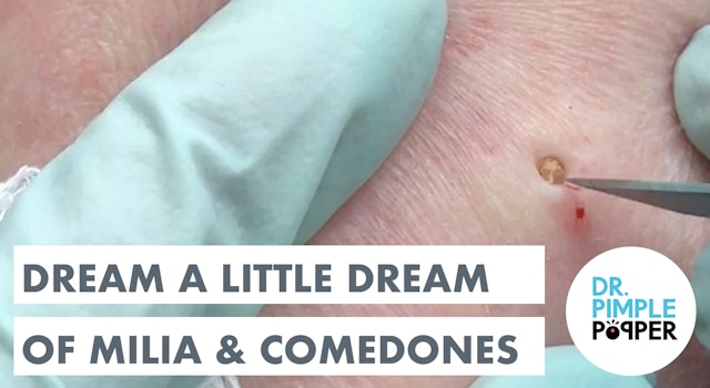Medley: Dream a Little Dream of Milia & Comedones