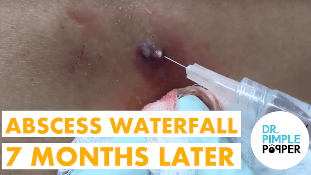 Abscess Waterfall..7 Months Later