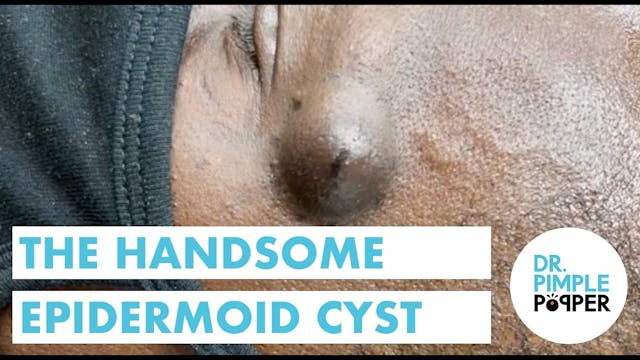 The Handsome Cyst 