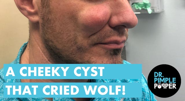 The Cheeky Cyst That Cried Wolf