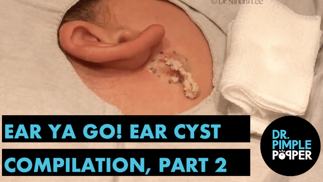 Ear Ya GO! Ear Cyst Compilation Part 2