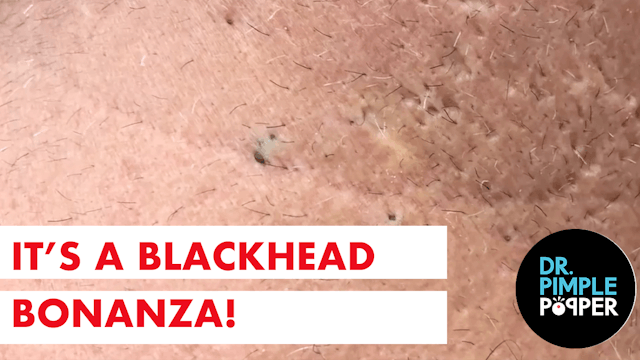 A Blackhead Bonanza