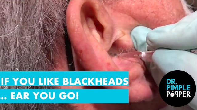 If you like blackheads, EAR ya go!