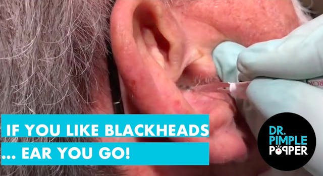 Ear blackheads deals 2019