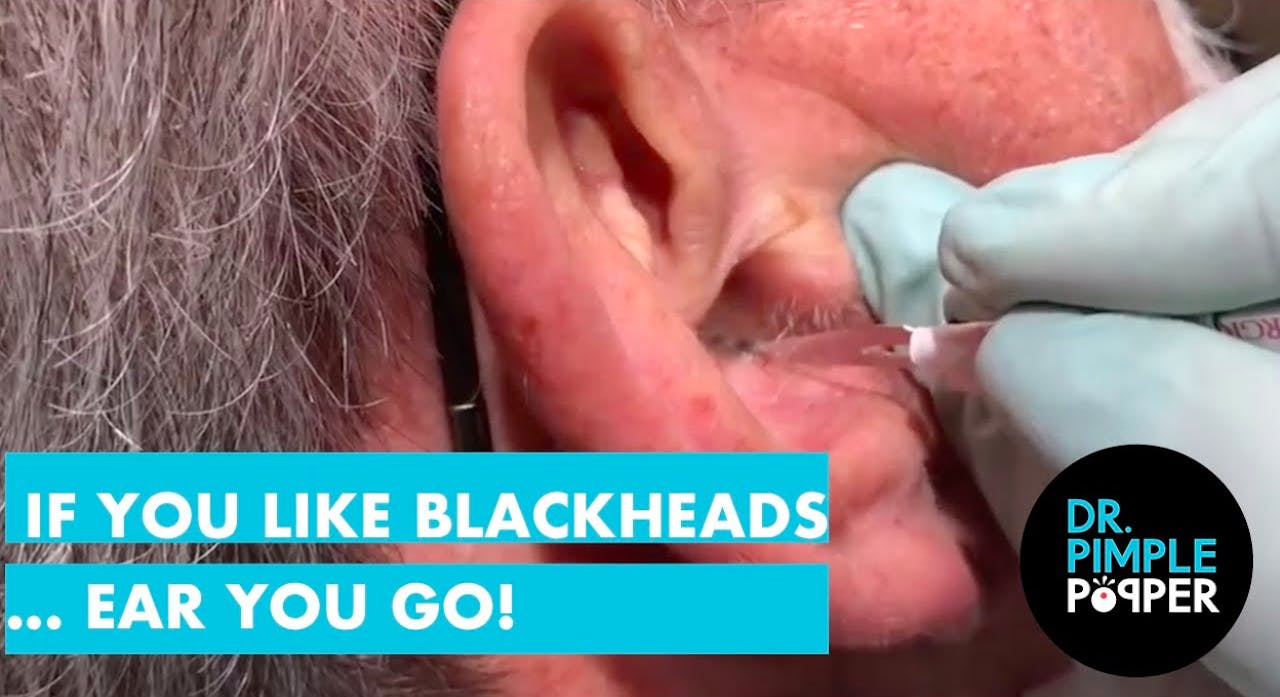 you like blackheads, EAR ya go! - Bedtime - Pimple Popper