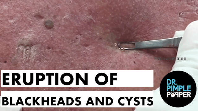 Were These Blackheads & Cyst from Age...
