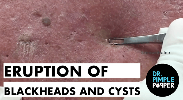 Were These Blackheads & Cyst from Agent Orange?