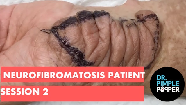 Neurofibromatosis patient session 2: Excision of large Neurofibroma