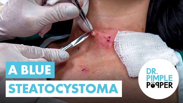 A Blue Steatocystoma!?