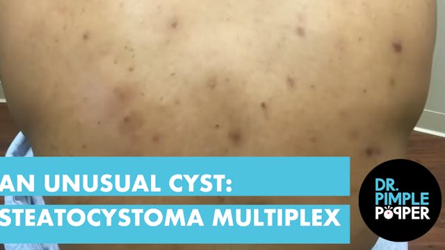 An Unusual Cyst: Steatocystoma Multiplex