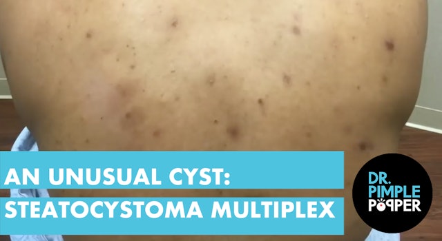 An Unusual Cyst: Steatocystoma Multiplex