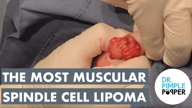 The Most Muscular Spindle Cell Lipoma
