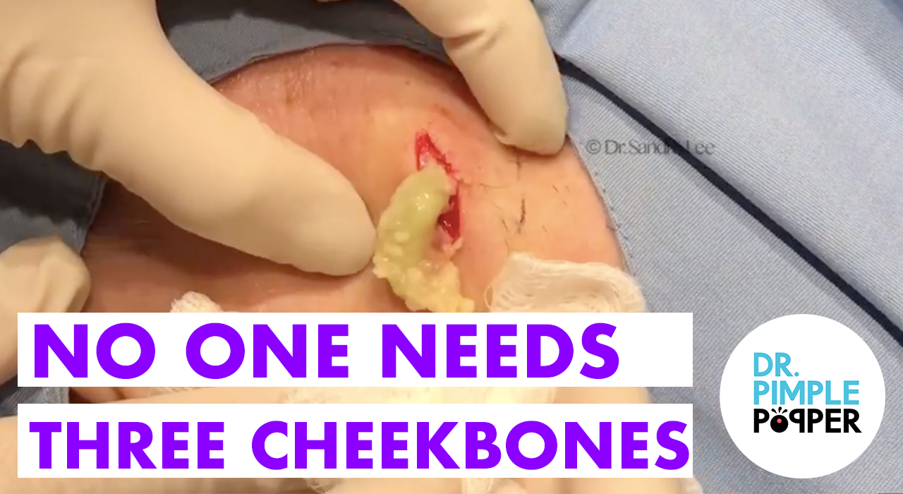 Cystactular Cysts Dr. Pimple Popper