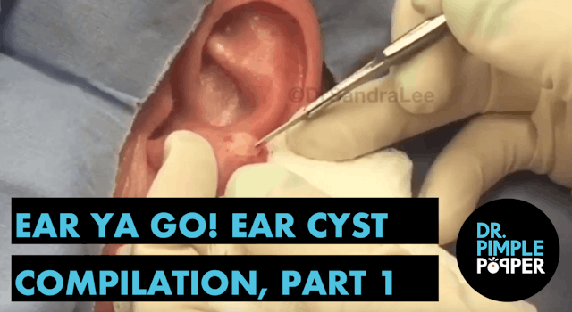 Ear Ya GO! 👂🏽Ear Cyst Compilation Part I