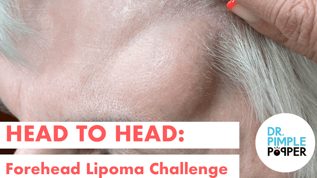Head to Head: Forehead Lipoma Challen...