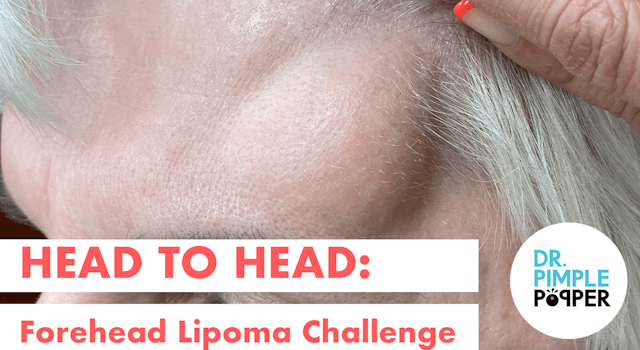 Head to Head: Forehead Lipoma Challen...