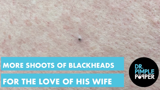 More SHOOTS of Blackheads for the Love of His Wife