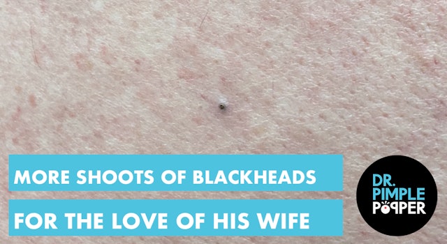 More SHOOTS of Blackheads for the Love of His Wife