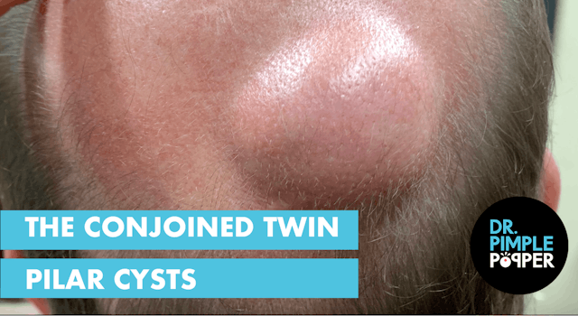 The Conjoined Twin Pilar Cysts