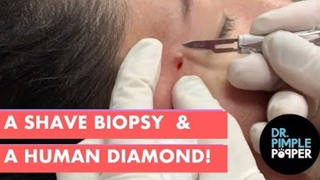 A Shave Biopsy and a Human Diamond