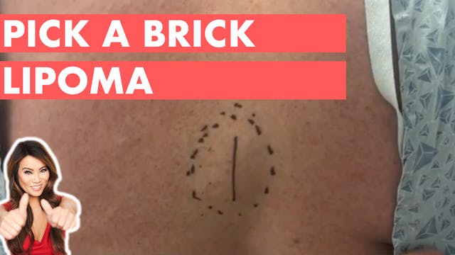 The Pick A Brick Lipoma