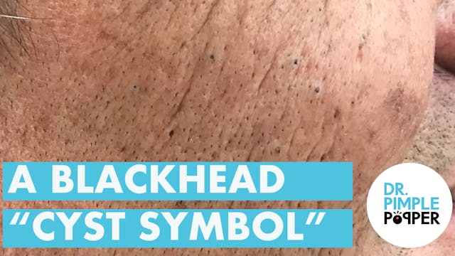 A Blackhead "Cyst Symbol"