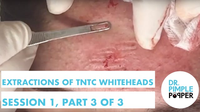 Extractions of TNTC Whiteheads: Sessi...