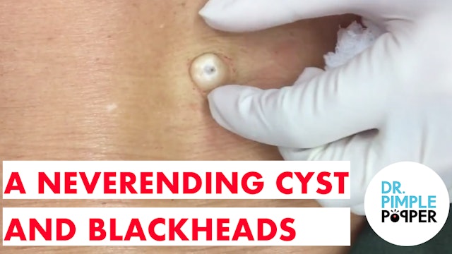 A neverending cyst and blackheads extracted