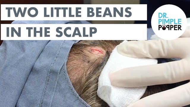 Two Little Beans in the Scalp