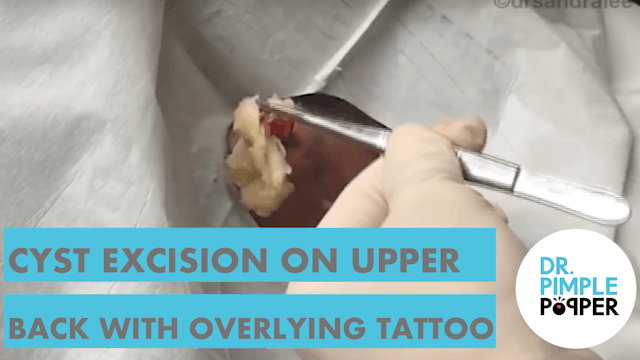 TBT: Cyst Excision on Upper Back