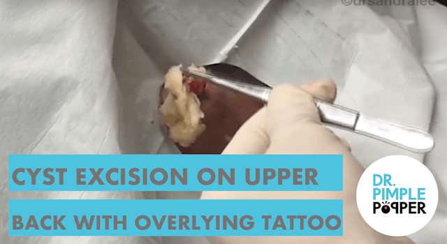 TBT: Cyst Excision on Upper Back