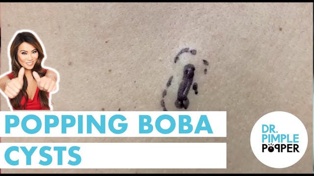 Popping Boba Cysts