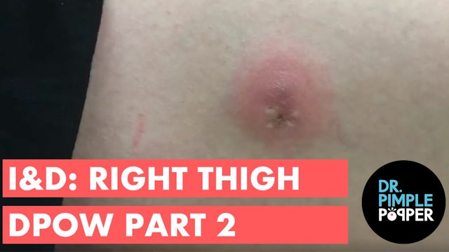 Follow up I&D of a Dilated Pore of Winer, Right Thigh